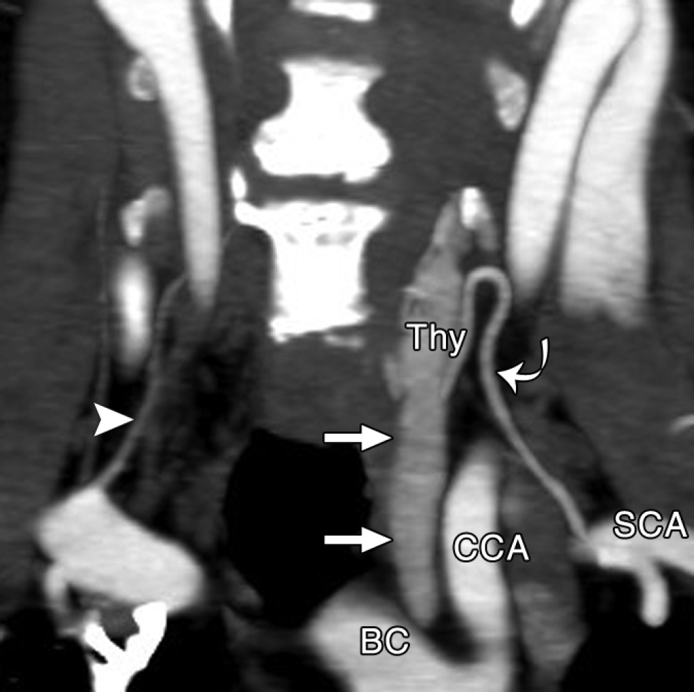 Coronal arterial phase 4D CT image shows a lesion measuring up to 4 cm in craniocaudal dimension